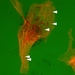 The image shows invadopodia (arrow heads), actin-rich protrusions at the adherent surface of an invasive melanoma cell (red).  Proteases directed to invadopodia degrade the extracellular matrix (dark spots on the green fluorescent matrix).