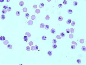 Second gene implicated in malaria parasite resistance evolution to chloroquine